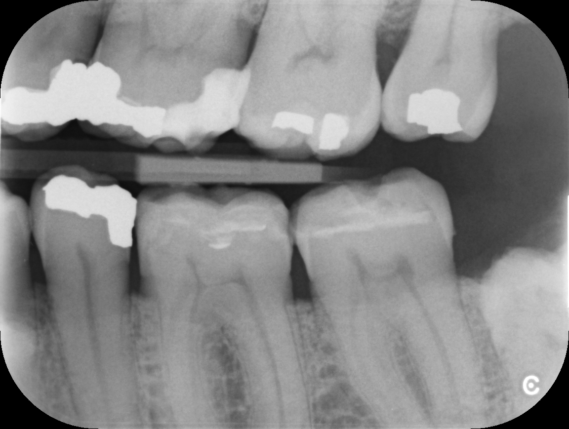 Example of an Intra-oral x-ray