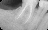 Molar Tooth with infection in the bone - dark area - Root filled