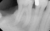 Molar Tooth with infection in the bone - dark area