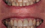 Emax Porcelain veneers and replacement crown on upper incisors