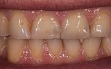 Simple white filling placement -after image - Central incisor