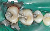 3 Amalgam Fillings about to be replaced under rubber dam before