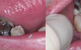 Amalgam fillings removed  and teeth prepared for Emax overlay Crowns under rubber dam 
