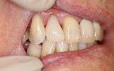 Same day Emax Porcelain crown to repair a fractured tooth After