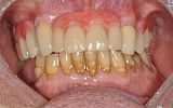 Missing upper teeth replaced with special attachment crowns and chrome cobalt denture