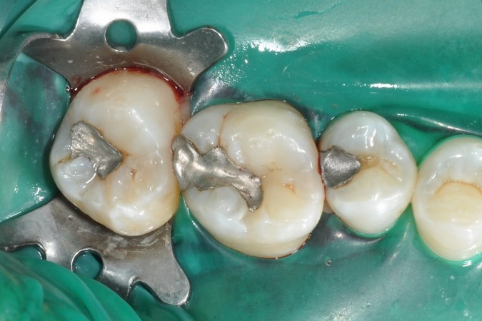Teeth isolated using rum dam ready to have mercury amalgam removal