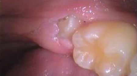 Impacted wisdom tooth just poking through the gum