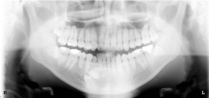 Panorex full mouth x-ray