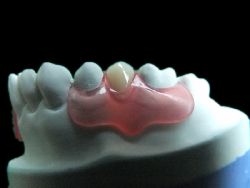 Valplast Denture