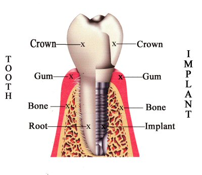 Dental Implant