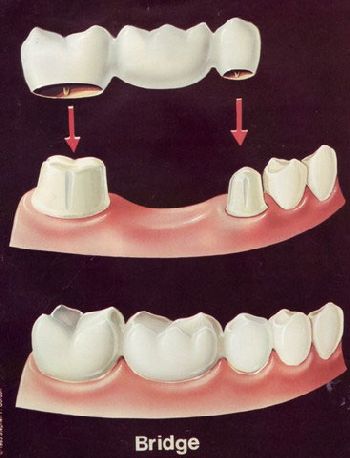 Fixed Porcelain Bridge