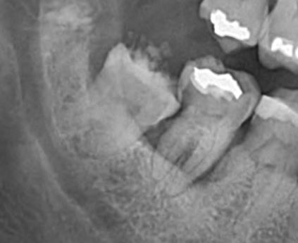 Wisdom tooth has caused unfixable decay in the tooth in front