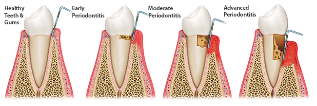 Types of Gum Infection