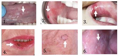 oral-cancer