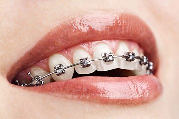 Ensuring Smiles Shine: The Crucial Role of Dental Check-ups and Hygiene Cleans During Orthodontic Treatment
