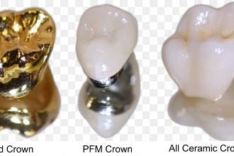 Why should I have a crown fitted after having a root canal treatment