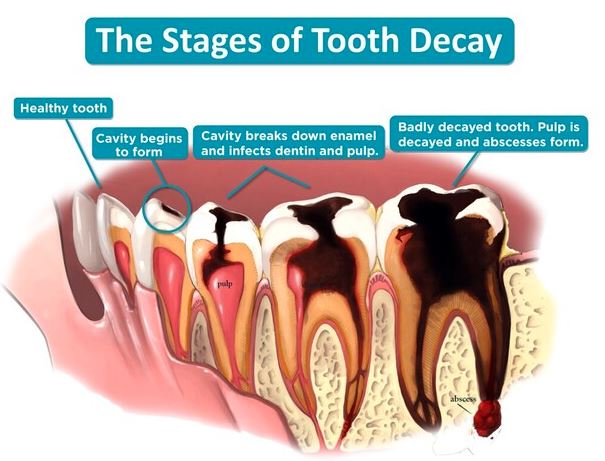 stages-of-tooth-decay
