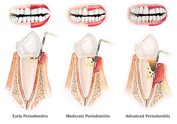 three-stages-of-periodontitis