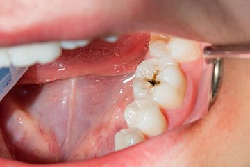 How can you prevent tooth decay?