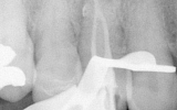 Premolar Tooth root filled 