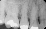 Premolar Tooth with infection in the bone - dark area