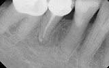 Premolar Tooth with infection in the bone - dark area - root filled 