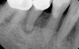 Premolar Tooth with infection in the bone - dark area