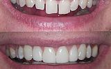 4 Emax Porcelain veneers to close gaps