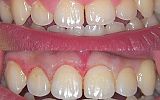 Laser Gum sculpting immediately after treatment