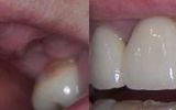 3 Tooth Valplast Denture 