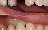 Lost tooth replaced with dental implant supported porcelain crown