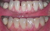 2 sameday emax porcelain veneers to close gaps 