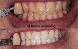 At Home Tooth Whitening