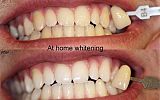 At Home Tooth Whitening