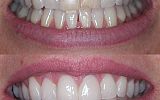 3 sameday emax porcelain veneers and tooth whitening