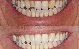 Tooth whitening & composite resin filling build ups