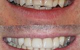 4 Emax overlay crowns