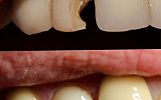 Badly broken and decayed tooth restored with composite resin filling