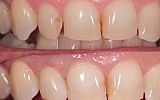 Simple white filling replacement