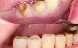 2 same-day emax porcelain crowns