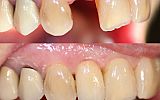 Lost tooth replaced with dental implant supported porcelain crown