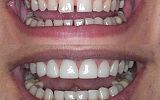 7 Emax Porcelain veneers to close gaps