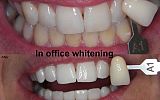 In office Tooth Whitening