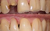 Composite Resin Filling Build Up