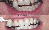 In office Tooth Whitening