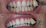 At Home Tooth Whitening