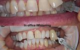 In office Tooth Whitening