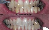 At Home Tooth Whitening