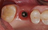 missing tooth replaced with an implant supported porcelain crown before