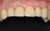 missing tooth replaced with an implant supported porcelain crown after